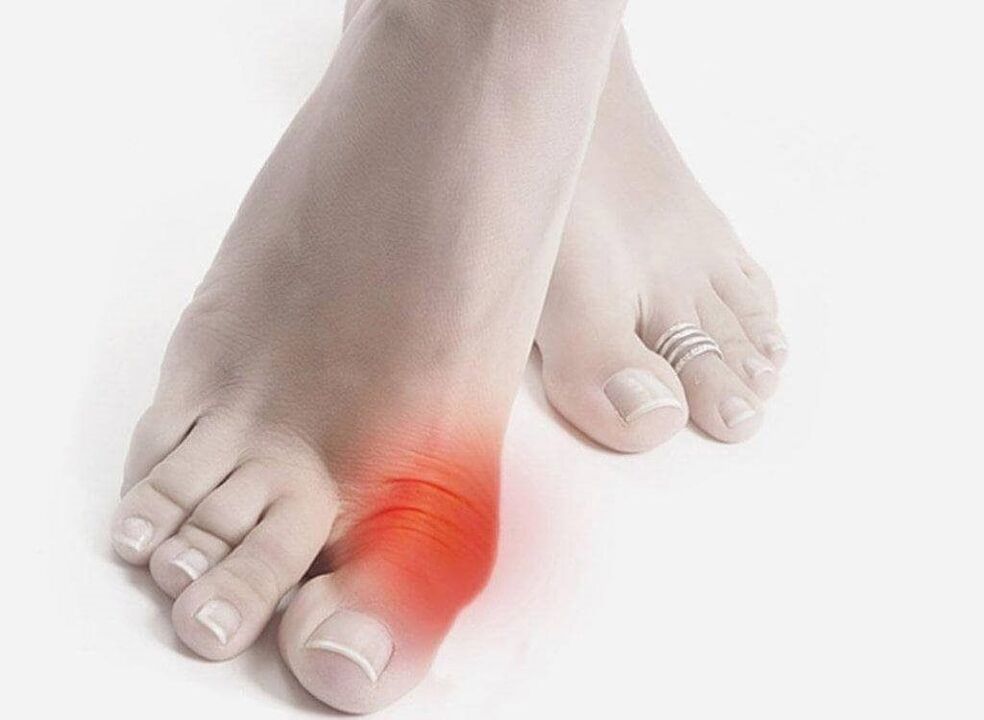 symptoms of gout in the legs