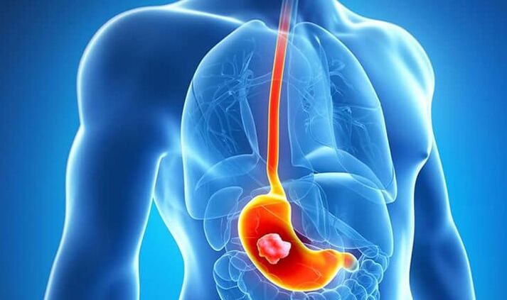 If you have a stomach ulcer, the Dukan diet is contraindicated.